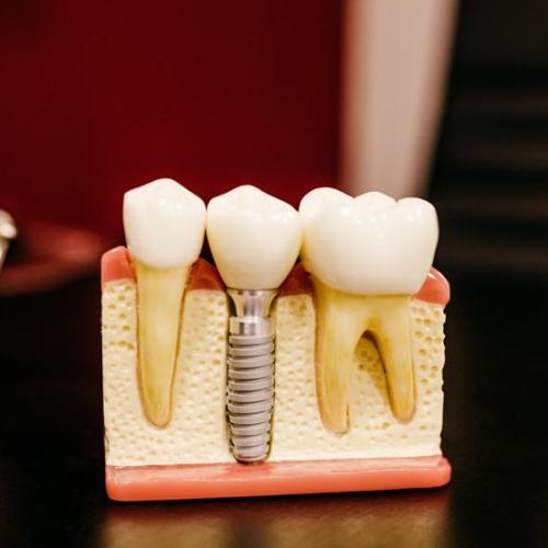 Implantes Dentários