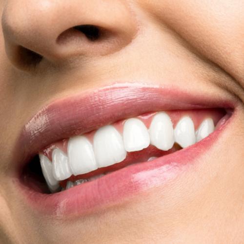 Clareamento Dental
